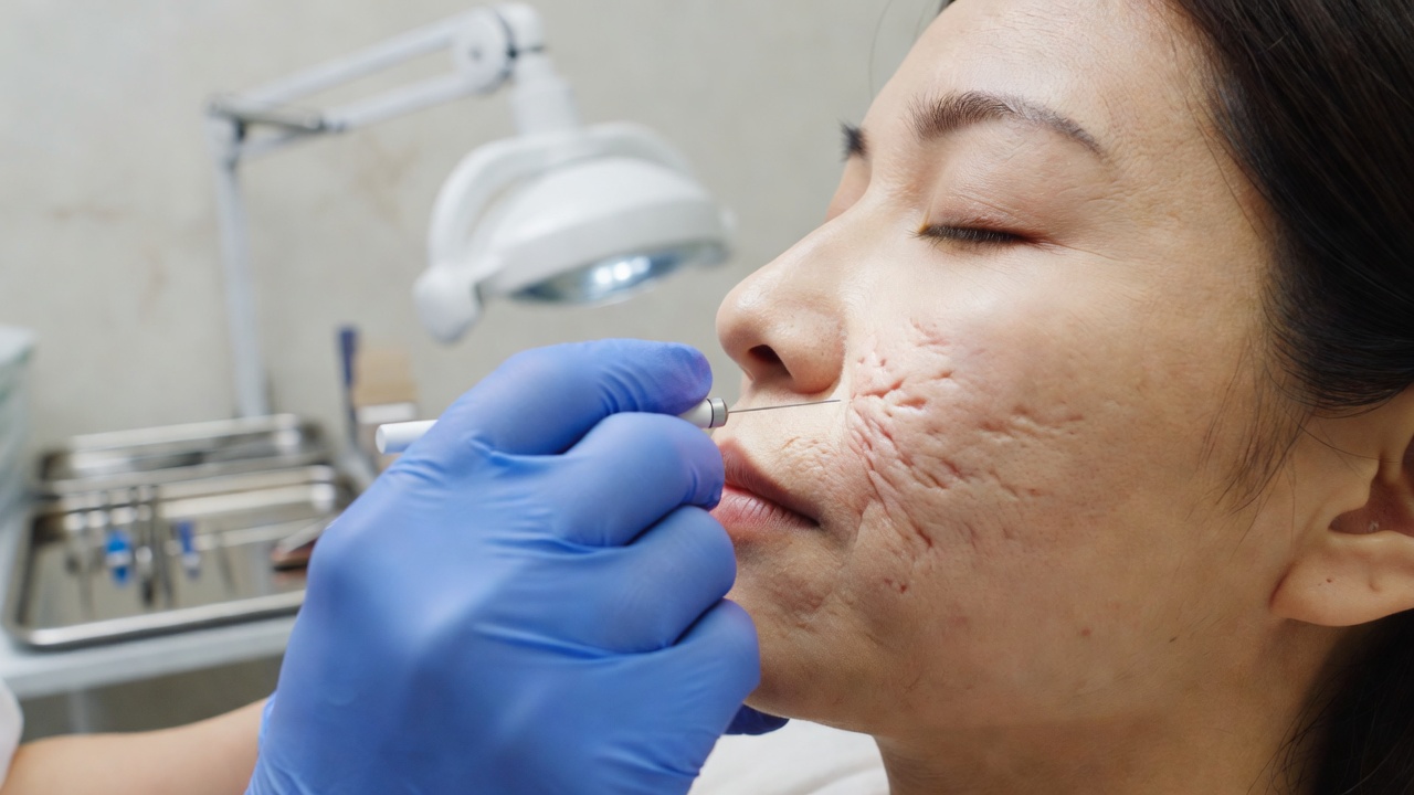 패인 여드름 흉터에 새살침으로 유착을 풀어주는 치료 장면